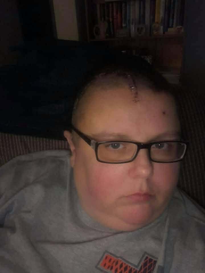 Christina showing a cranial suture from surgery