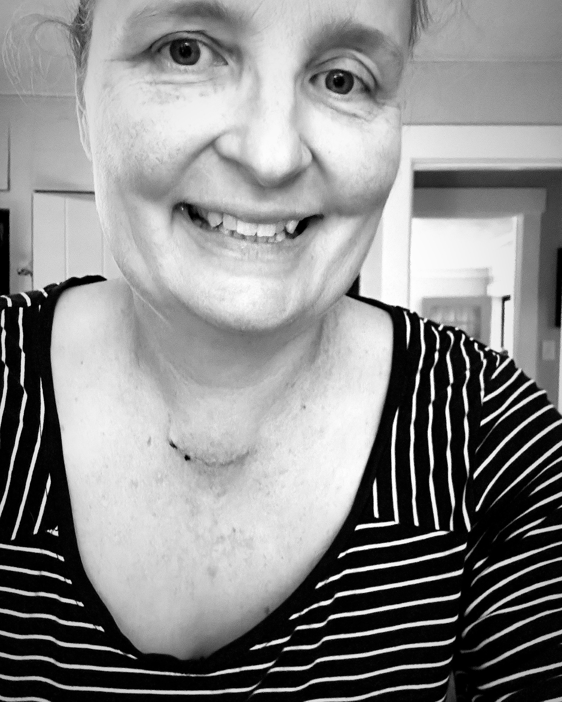 smiling woman in a black and white striped shirt displays thyroidectomy scar